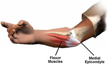 An Arm showing the Muscles affected by Golfers Elbow